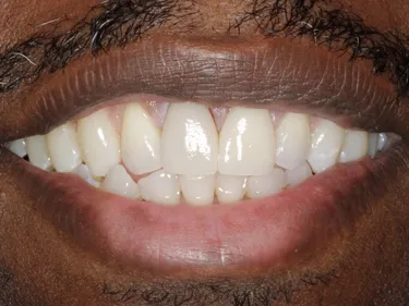 Porcelain Crowns after