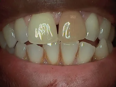Before porcelain crowns