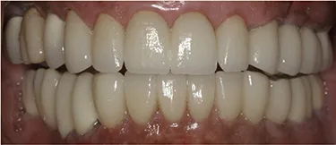 Dental Implants After