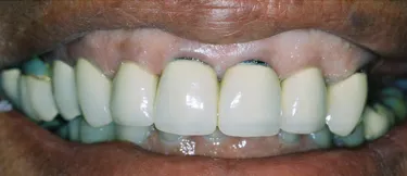 Dental Implants Before