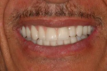 Dental Implants After