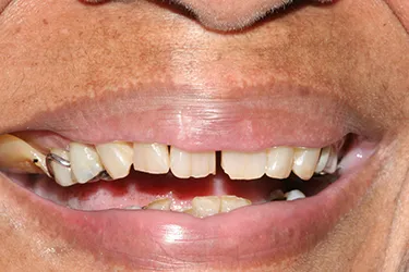 Dental Implants Before