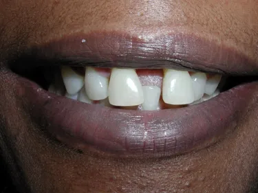 Porcelain Veneers before