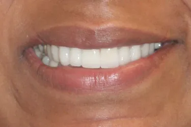 Porcelain Veneers after