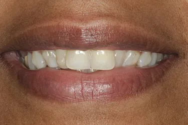 Porcelain Veneers before