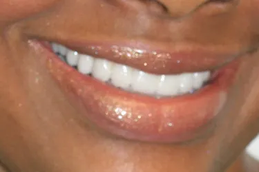 Porcelain Veneers after