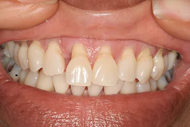 Porcelain Veneers before