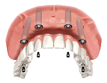 All on 4 Implant Example 2