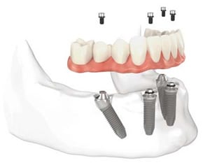 All on 4 Implant Example