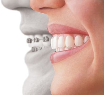 Invisalign Treatment vs. Traditional Braces