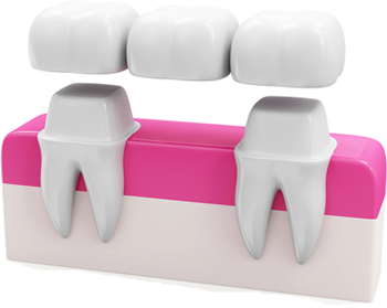 Dental bridge