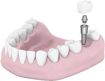 Image of Dental Implants procedure