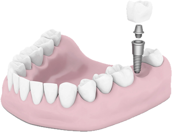 Image of Dental Implants procedure