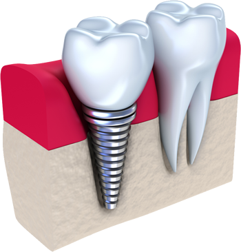 image of implant2