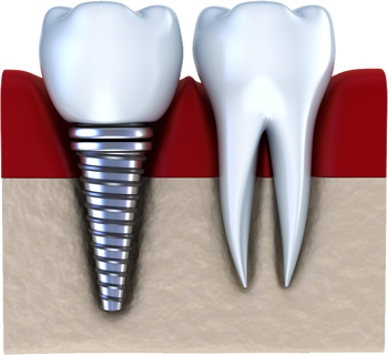 implant4